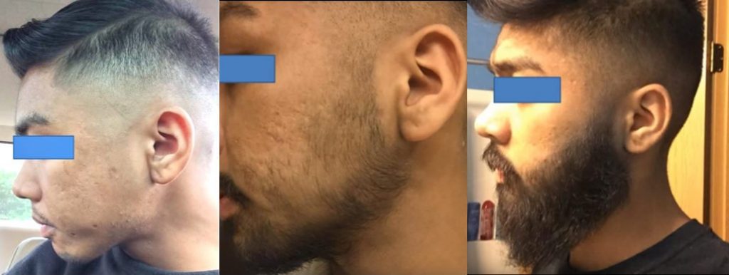 Baardgroei stimulant: Minoxidil